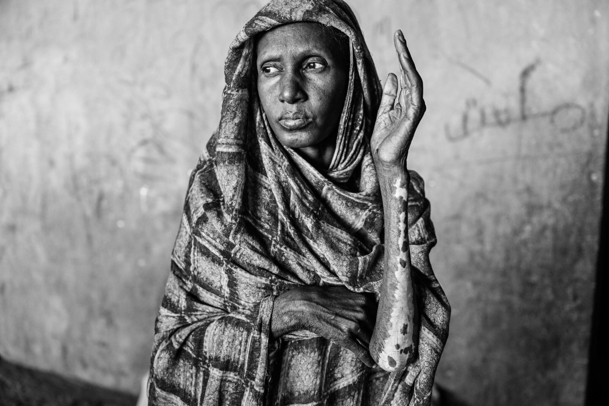 Black and white photo of a woman wearing a striped headscarf, looking to the side with a thoughtful expression. Featured at the World Press Photo Exhibition 2025 Brisbane Powerhouse, her raised arm shows patches of depigmented skin.